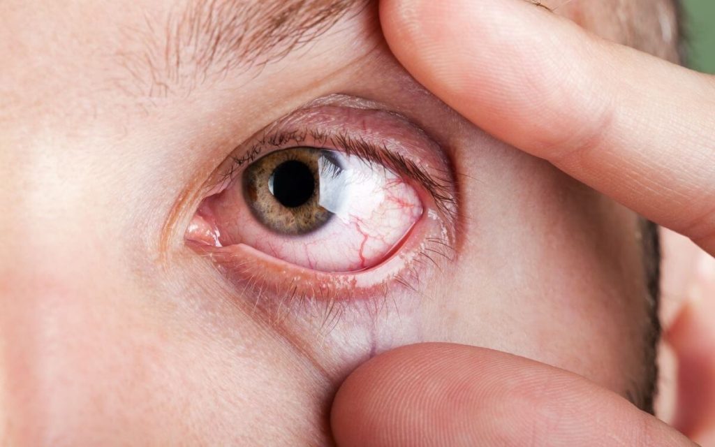 enfermedades comunes de los ojos